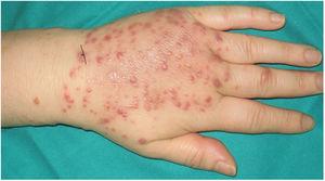 Multiple erythematous-violaceous papules of 3–4  mm on the back of the left hand.