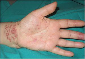 Similar lesions on the palm and wrist of the left hand, and an erosion on the palmar aspect of the third finger of the same hand.