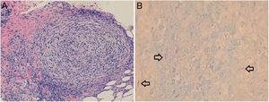A, Hematoxylin-eosin staining shows well-defined granulomas, consisting of histiocytes and peripheral lymphocytes, located in the reticular dermis and hypodermis. B, Fite-Faraco staining reveals the presence of acid-alcohol resistant bacilli.
