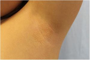 Millimeter-sized confluent perifollicular papules with a yellowish color and elastic consistency, in the left armpit.
