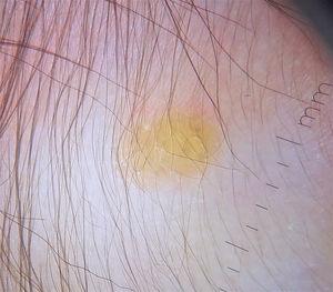 Dermatoscopy showing a pale lesion with an erythematous halo (setting sun pattern).