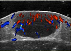 Color Doppler ultrasound. Note the hypoechogenic, nodular dermal formation with a solid appearance and well-defined borders pushing up the epidermis. Note the moderate vascularization in the interior of the lesion.