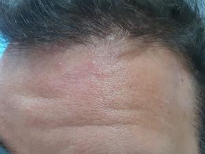 Treated cutaneous leishmaniasis. Atrophic scar with peripheral hyperpigmentation on the forehead upon completion of 8 sessions of photodynamic therapy and intralesional meglumine.
