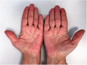 Erythema on the palmar surface of the fingers.
