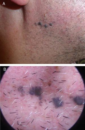 A, Four bluish papules (3–4 mm in diameter) surrounded by minute satellite lesions. B, Dermoscopy image showing a homogeneous blue pattern.
