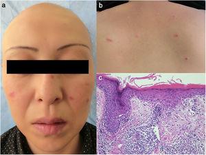 (a) Alopecia totalis on the scalp and erythema scattered on the cheek, nose, and lips. (b) Infiltrative erythemas on the upper cheek. (c) A biopsy specimen showing epidermal atrophy, liquefaction of the basement membrane, dyskeratotic epidermal cells, and focal mononuclear cell infiltration in the dermis.