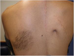 Hyperpigmented macule with hair over the left shoulder. Note the adjacent surgical scar due to the history of severe scoliosis.
