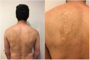 Adult patient who presented macules that simulate grouped hyperpigmented islands located on the left scapular region.