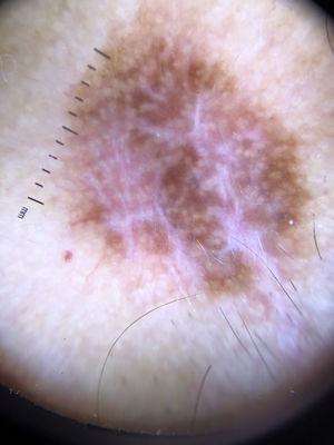 Thick melanoma with white shiny structures, defined as thick, linear, white structures dispersed in an orthogonal or stellate pattern.