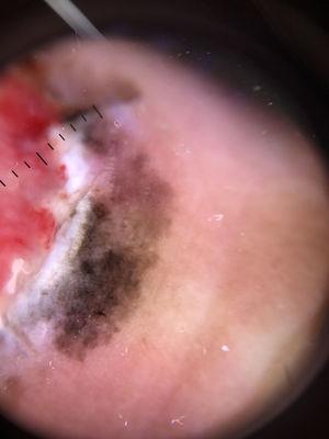 Thick melanoma with milky-red areas, defined as fuzzy or unfocused milky-red globules and/or larger areas.