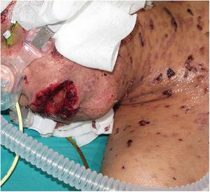 Multiple generalized blisters, erosions, and scabs with severe involvement of the oral mucosa.