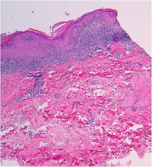 Hematoxylin–eosin, × 40. Intense lichenoid interface dermatitis.