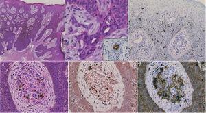 Histological features showing basophilic tumor nests extending from the epidermis to the mid-dermis (haematoxylin and eosin) (a). Higher magnification shows ductal structures within the nests (b), which were positively stained for CEA (insert). MART-1 stain revealed an increased number of melanocytes within the tumor nests (c). A number of melanin deposition within the tumor nests, as well as melanophages and amorphous materials in the stroma (d). Amorphous materials in the stroma were positively stained with Congo-red (e) and CK5 (f) (original magnification a:×40, b: ×200, c: ×100, d-f: ×400).