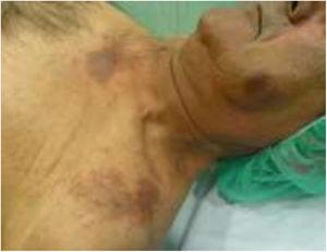 Erythematous–violaceous plaques on the face and upper chest.