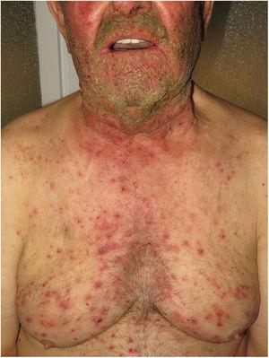 Rash associated with the EGFR inhibitor cetuximab.