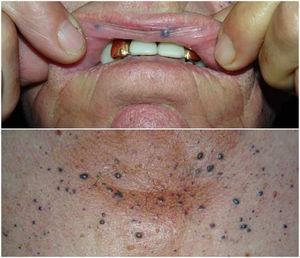 Clinical image of venous malformations in the oral mucosa, perioral skin, and presternal area.