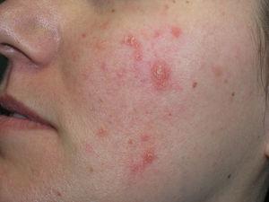Scaling papules with a seborrheic appearance on the cheeks.