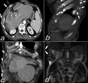 (a•d) Abdominal CT scan, axial slice (a), sagittal (b), coronal (c), and coronal T2-weighted magnetic resonance imaging (d) show local metastasis to the skin, subcutaneous tissue (solid arrows), pleura, ribs (empty arrows) and sternum xiphoid process (white star).