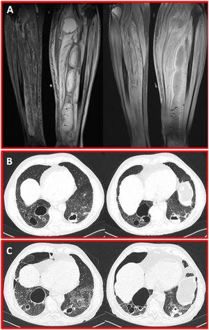 (A) Coronal proton density and postcontrast T1-weighted MR images show giant intramuscular abscesses in the posterior of the left cruris. (B) Axial CT scans in parenchyma window show multiple cavitary septic embolisms in both lungs. (C) Control CT scans five days after from the presentation scan reveal the right pneumothorax secondary to septic embolism.