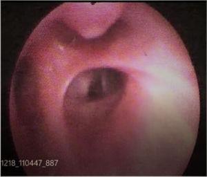Bronchoscopic view demonstrating nipple-like projection at the opening of right upper lobe apical segment.