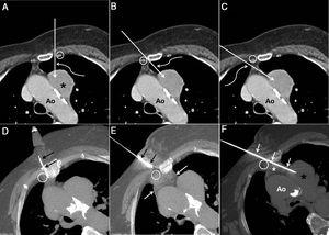 (A) Axial CT image of the chest with intravenous contrast medium, showing a paraaortic mass in the anterior mediastinum (asterisk). The straight arrow shows the theoretical path of the biopsy needle in a left parasternal approach between the left inner mammary vessels (circle) and the left edge of the sternum. Note that the aortic arch (Ao) is in the theoretical path of the biopsy needle. The curved arrow shows that the left lung parenchyma would be punctured using this access. (B) Axial CT image of the chest with intravenous contrast medium in which the straight arrow shows the theoretical path of the biopsy needle using a right parasternal medial approach to the right internal mammary vessels (circle). Note that the aortic arch (Ao) is not in the theoretical path of the biopsy needle, but that this approach also punctures the left pulmonary parenchyma (curved arrow). (C) Axial CT image of the chest with intravenous contrast medium in which the straight arrow shows the theoretical path of the biopsy needle using a right parasternal lateral approach to the right internal mammary vessels (circle). Note that the aortic arch (Ao) is also not in the theoretical path of the biopsy needle, but that this approach punctures the right pulmonary parenchyma (curved arrow). (D) Axial CT image of the chest obtained during the biopsy procedure using the CPLA, with the patient in the semi-right lateral decubitus position, showing an intramuscular needle (arrows) between the right internal mammary vessels (circle) and the right sternum margin for local instillation of saline (hydrodissection). (E) Axial CT image of the chest obtained during the biopsy procedure using the CPLA with the patient in the semi-right lateral decubitus position. After expanding the anterior mediastinum using hydrodissection (white arrows), the biopsy needle is inserted (black arrows) into the chest wall. Note that the biopsy needle is directed into the space between the right internal mammary vessels (circle) and the right edge of the sternum. (F) Axial CT image of the chest obtained during the biopsy procedure by CPLA, with the patient in the semi-right lateral decubitus position, where the biopsy needle (arrows) has been advanced to the paraaortic mass (black asterisk) through the space between the right edge of the sternum and the right internal mammary vessels (circle). Note the presence of a “salinoma” (white asterisk) in the anterior mediastinum and the parallel trajectory of the biopsy needle to the aortic arch avoiding any possibility of damaging the aorta (Ao).