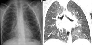 Plain X-ray of the chest (A). Hyperinflation of both hemithoraxes and increased lung parenchyma density in the perihilar region. Chest CT, coronal reconstruction (B). Areas with a ground glass pattern affecting predominantly the middle lobe and the lingula, showing the typical distribution pattern of neuroendocrine hyperplasia of infancy.
