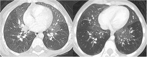 Chest CT, axial slice at the level of the lingula. Initial comparison (A) and 1 year later (B). Areas with a ground glass pattern affecting predominantly the middle lobe and the lingula, showing the typical distribution pattern of neuroendocrine hyperplasia of infancy.