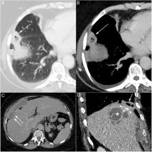 Axial chest CT images obtained with lung (A) and mediastinal (B) window settings demonstrate a small, nodular, cavitary pulmonary lesion in the right lower lobe (arrows). An abdominal CT (C) image shows a large and complex perihepatic collection containing two calcified gallstones (arrows) adjacent to the right hepatic lobe. A sagittal thoracoabdominal reconstruction (D) demonstrates the abdominal collection (asterisk) adjacent to the pulmonary abscess (arrow). Note also the gallstones inside the lesion (arrowheads).