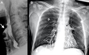 (A) Side view of esophagography with barium. The white arrow points out the leakage into the larynx. (B) Front view of chest X-ray. The white arrow marks the segmental bronchi of the lower right lobe. The black arrow shows the upper edge of the left main bronchus.