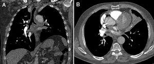 (A) Post-contrast coronal CT scan reveals diffuse thickened tracheobronchial wall. (B) Axial CT scan shows atelectasi in the lingular segment of the left upper lobe.