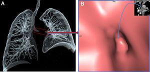 Three-dimensional volume-rendered air-specific coronal plan MDCT image (A) and virtual CT bronchoscopy (B) demonstrate obstruction (frame and arrow) of the left main bronchus.