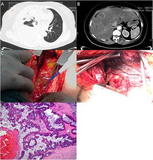 Chest CT scan showed massive pleural effusions on the right side with local atelectasis of the right lung (A). Abdominal CT scan revealed multiple low-density shadows of unequal size in the liver, and the edge of the lesions were slightly enhanced (B). An open thoracotomy revealed 1500ml free mucus in the right pleural space (C), and multiple masses along the pleura, diaphragm and liver (D). Postoperative pathological showed low-grade mucinous neoplasm (E).