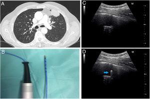 (A) Chest CT image shows a lingular mass with pleural contact and bronchus sign. (B) Flexible cryoprobe indicated for transbronchial biopsy. Outer diameter 1.9mm, length 900mm. (C) Transthoracic ultrasound image before performing transbronchial biopsy of the mass. (D) Transthoracic ultrasound image during the performance of transbronchial biopsy, which locates the cryoprobe within the lung mass (arrow).