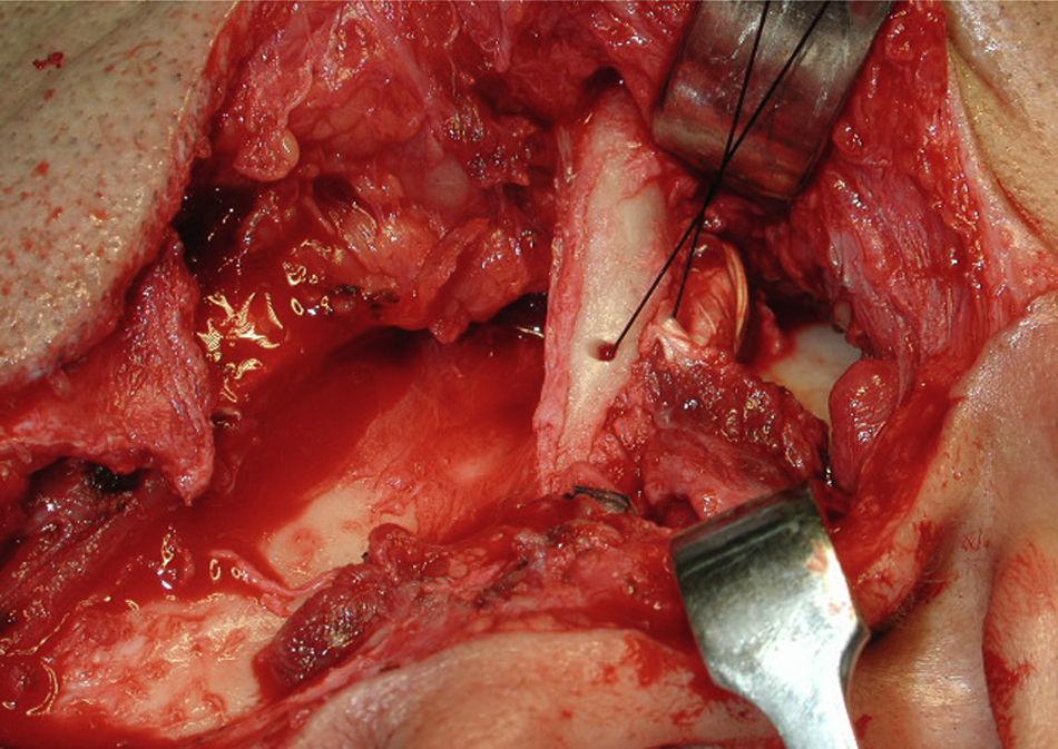 Tratamento/cirurgia da ATM