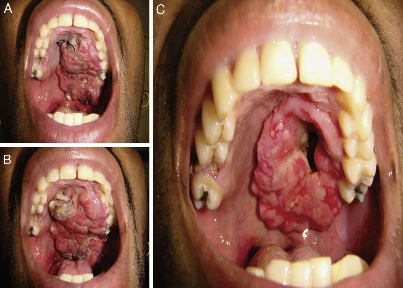 Thyreos - O câncer de mandíbula, é um tipo raro de tumor que se