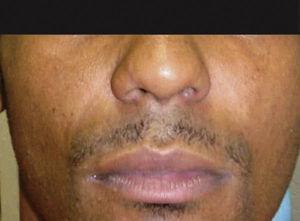 Exame clínico extraoral mostrando discreto inchaço do terço médio da face do lado à esquerda.