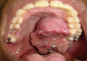 Exame clínico intraoral evidenciando lesão acometendo palato duro até palato mole à esquerda.