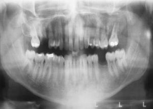 Radiografia panorâmica demonstrando área osteolítica, mal delimitada, na parte esquerda da maxila.