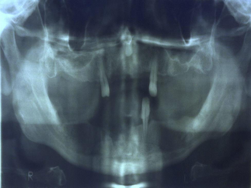 Radiografia Panorâmica de Mandíbu-la. Pós-Operatório de cinco meses.