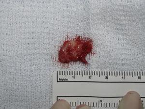 Cyst enucleated.