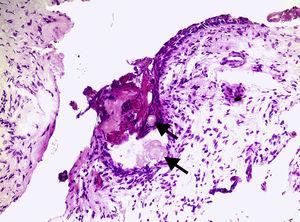 Características histopatológicas da lesão, mostrando cápsula cística revestida por epitélio odontogénico, com presença de células fantasmas, indicadas pelas setas (HE, 200X).