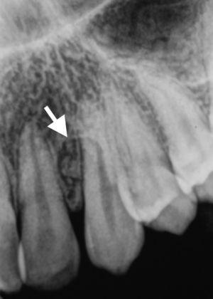 Radiografia periapical mostrando lesão radiotransparente unilocular, bem delimitada, contendo material radiopaco no seu interior, localizada na região anterior da maxila do lado esquerdo, projetada na região das raízes dos dentes 22 e 23 (indicada pela seta).
