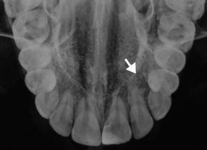 Radiografia oclusal total de maxila mostrando a lesão (indicada pela seta).
