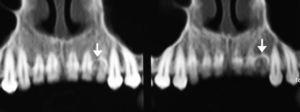 Exame tomográfico em reconstrução panorâmica mostrando a íntima relação da lesão com as raízes dos dentes 22 e 23 sem, contudo, promover reabsorção radicular (indicada pela seta).