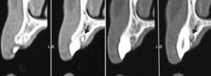 Exame tomográfico em cortes transversais mostrando a localização palatina da lesão (indicada pela seta).