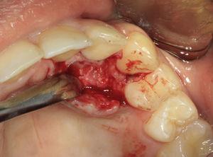 Biópsia excisional: exposição da lesão após descolamento de retalho mucoperiósteo.