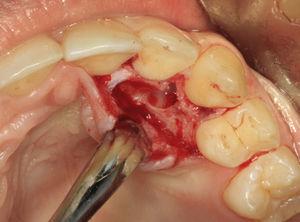 Biópsia excisional: loja cirúrgica após a curetagem da lesão.