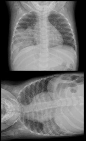 Radiografía de tórax anteroposterior y con rayo horizontal.