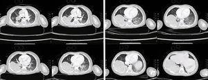 Tomografía de tórax con contraste, ventana pulmonar.