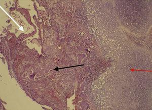 Flecha negra: lesión tumoral con células neoplásicas con escaso material osteoide; flecha blanca: vasos telangiectásicos; flecha roja: cartílago (hematoxilina-eosina, aumento 10x).